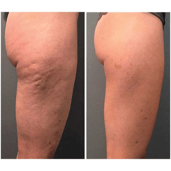 Cellulite Treatment Supriya Dermatology West Palm Beach FL