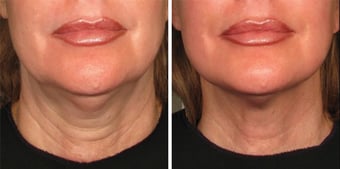 Before and After Dermatology | Supriya MD