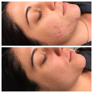 Chemical Peel Before and After | West Palm Beach Dermatologist | Supriya Tomar MD