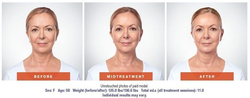 Kybella chin reduction in West Palm Beach