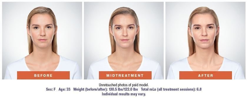 Double chin reduction in West Palm Beach