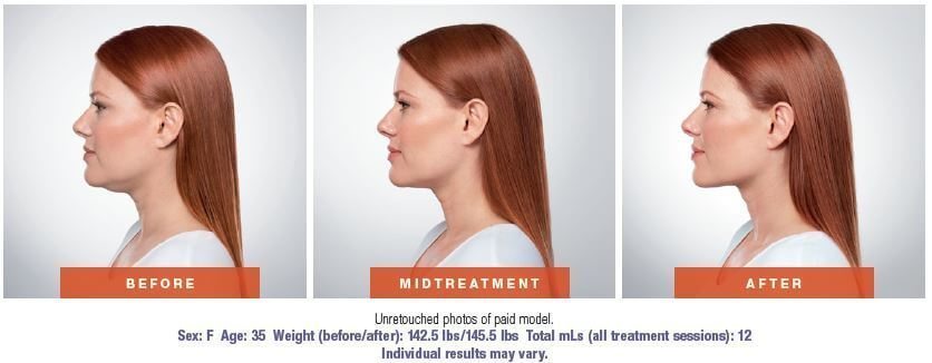 Double chin treatment in West Palm Beach