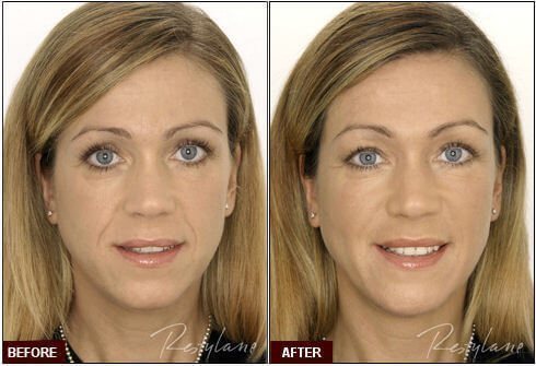 Restylane Fillers in West Palm Beach