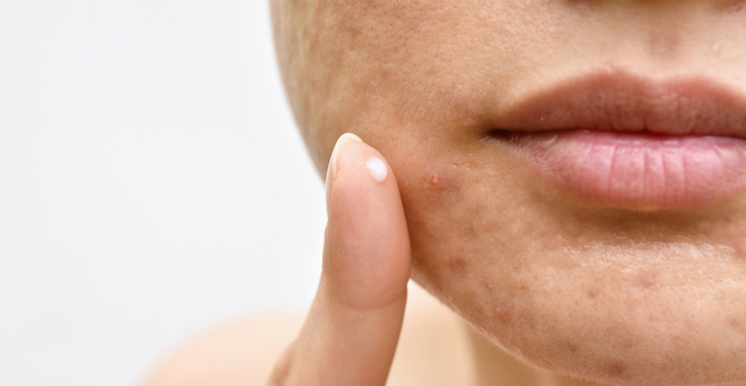 acne aging blog