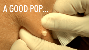 Pimple Popper | Supriya Tomar MD | Dermatologist in West Palm Beach