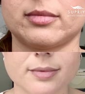 fillers for acne before and after