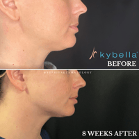 kybella before and after-2