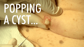 popping a cyst youtube thumbnail (1)